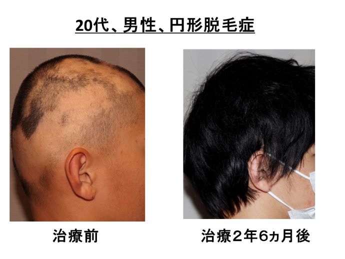 円形脱毛症　病院